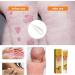 Bee Venom Cream for Psoriasis Cream Bee Venom Cream Psoriasis Treatment New Zealand Bee Venom Chinese Herbal Cream for Psoriasis Bee Venom Psoriasis Soothing Itching 20g (2) - Buy Online on SooperMarket.com