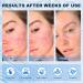 Azelaic Acid 10% Cream - Effective Acne & Rosacea Treatment for Clear Skin | Reduce Redness Breakouts & Pigmentation - Buy Online on SooperMarket.com