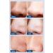 3-Step Blackhead Removal Nose Patch Deep Cleansing Blackhead Remover Nose Strips Newly Upgraded No Peeling No Pain Gentle to The Skin - Buy Online on SooperMarket.com