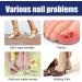 Ingrown Toenail Treatment - 30ML Ingrown Toenail Correction Drops - Nail Helper Ingrowth Toenail Treatment Oil - Trimming Toenail Softening Drops - Nail Fungal Treatment - Buy Online on SooperMarket.com