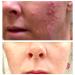 Mandelic Acid Peel 40% for Face - Professional Intense Chemical Peel for Rosacea, Acne, Hyperpigmentation & Melasma - Alpha Hydroxy Acid Skin Brightening Treatment - 1 Fl Oz - Buy Online on SooperMarket.com