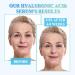 Hyaluronic Acid Serum for Face 95% Hyaluronic Acid & Vitamin C+E - Anti Wrinkle + Anti Aging Hydrochloric Acid Face Serum - Antiaging Hydrating Serums Skincare Dark Spot Remover for Face - Buy Online on SooperMarket.com