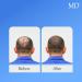 MD Hair Restoration Two Step System - Follicle Activator & Energizer for Hair Thinning Regrowth & Nourishment | Ideal for Men & Women - International Shipping Available - Buy Online on SooperMarket.com