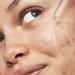 e.l.f. SKIN Blemish Breakthrough Triple-Acid Resurfacing Serum - Hydrating Night Serum with Niacinamide for Acne - Vegan & Cruelty-Free - Buy Online on SooperMarket.com