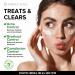 Acne Medication Face Cream - Fast Acting USA-Made Treatment for Stubborn Pimples, Blackheads, Whiteheads - Soothing Moisturizer for Acne Relief & Scar Prevention - 2oz - Buy Online on SooperMarket.com