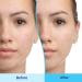 Differin Acne Treatment Gel 45g | Effective Acne Solution & Clear Skin - Buy Online on SooperMarket.com