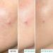 Erborian - Centella Acne Care - Soothing Moisturising Fluid 1% Bakuchiol/Patch Pimple Effect 10% PHA - Acne & Blemish Treatment - Korean Cosmetics SOS Patch - Buy Online on SooperMarket.com