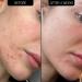 Shop The INKEY List SuperSolutions Acne Clearing Moisturizer 2% NOVORETIN - 1.7 oz / 50 ml Online - Best Price & International Shipping - Buy Online on SooperMarket.com