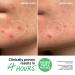 Shop The INKEY List Hydrocolloid Invisible Pimple Patches + Salicylic Acid Online - Best Price & International Shipping - Buy Online on SooperMarket.com